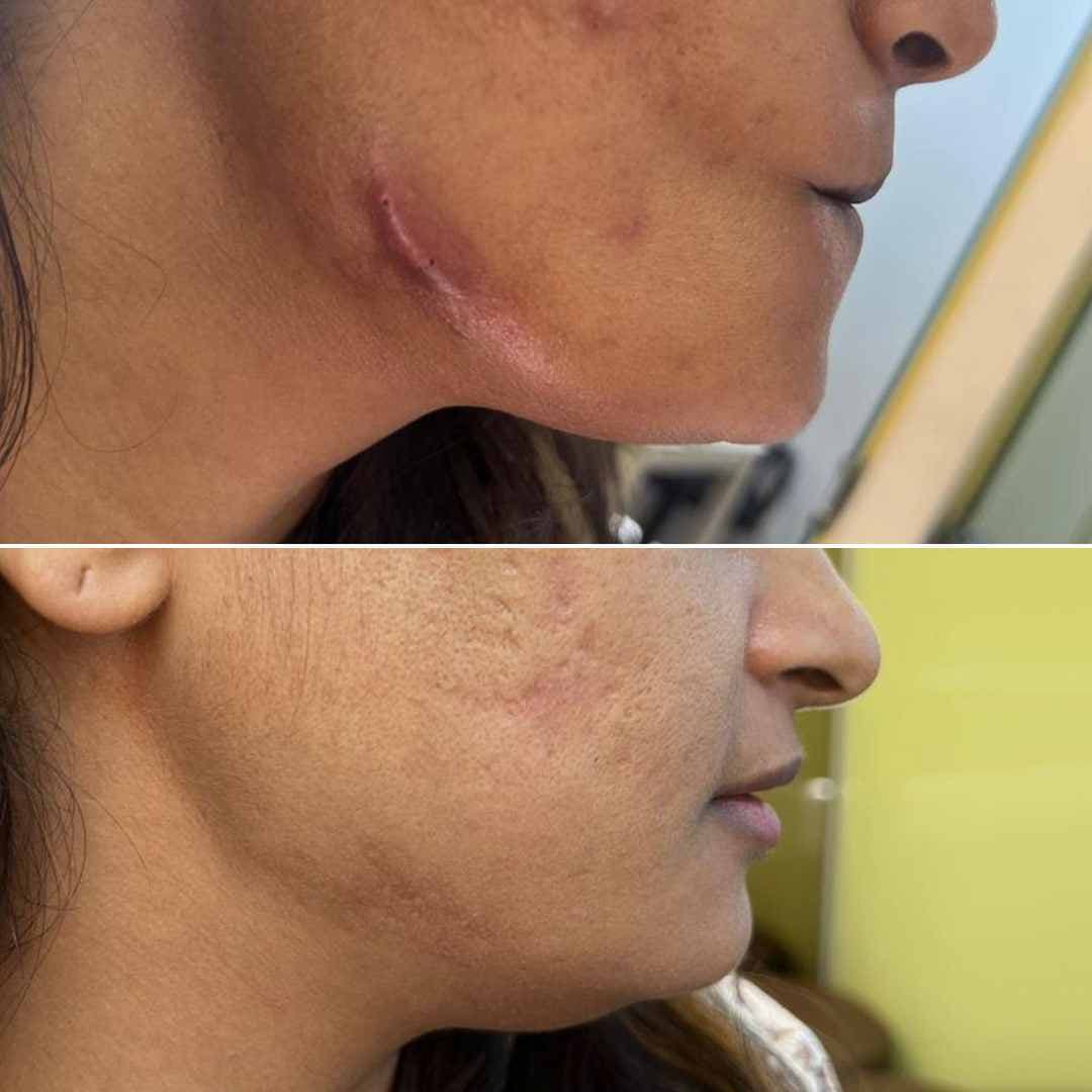 Acne Scar.jpg