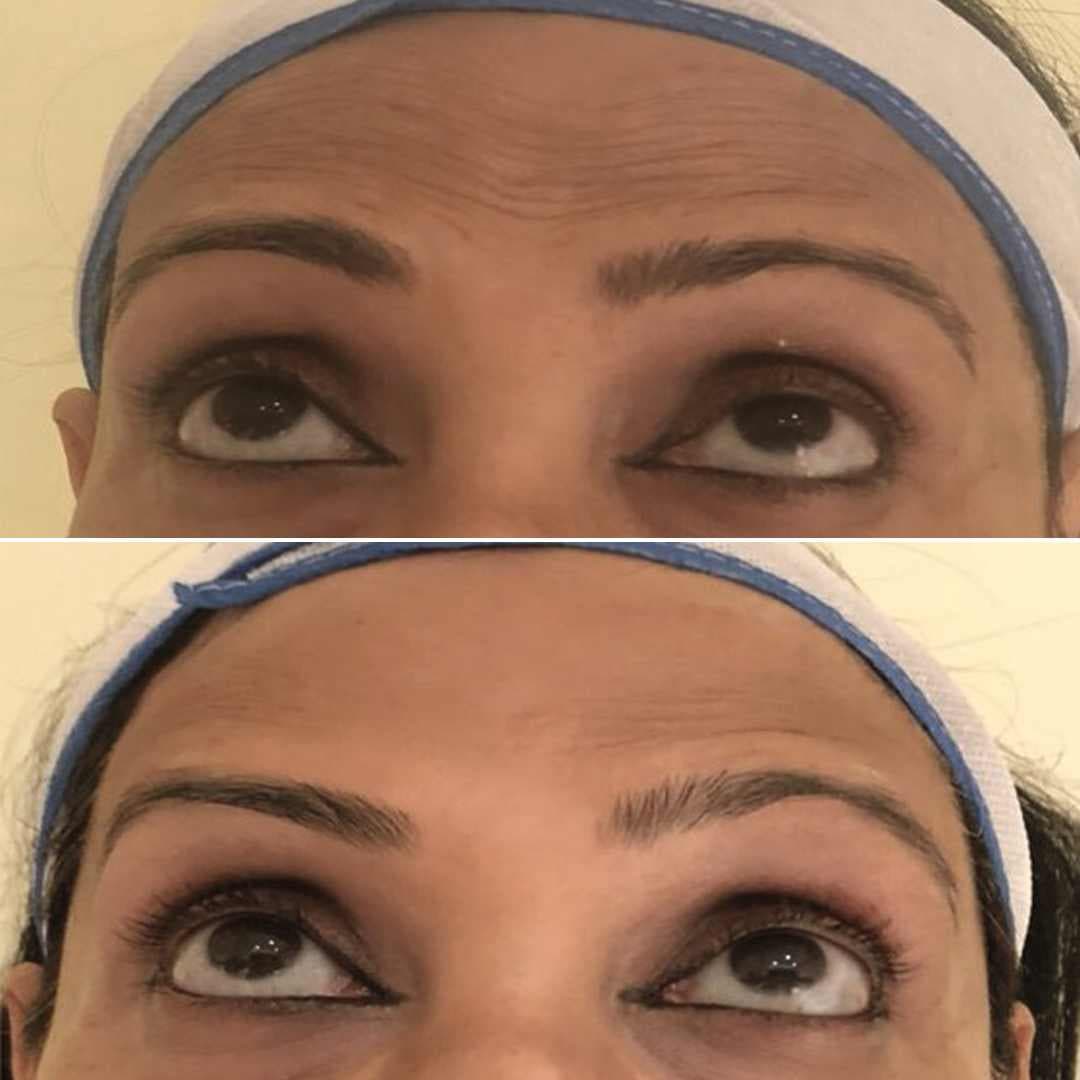 Botox-Forehead.jpg