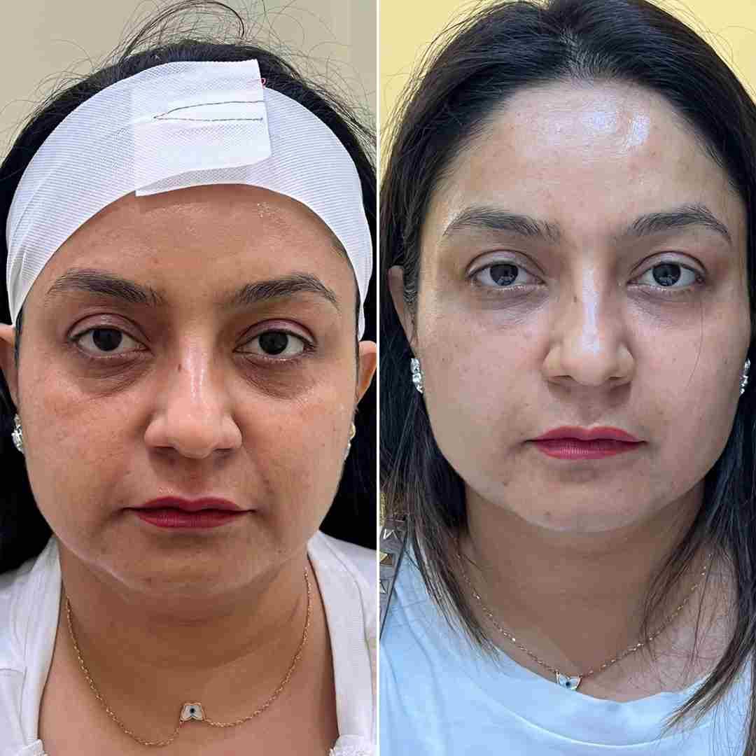 Copy of Full-face-filler.jpg