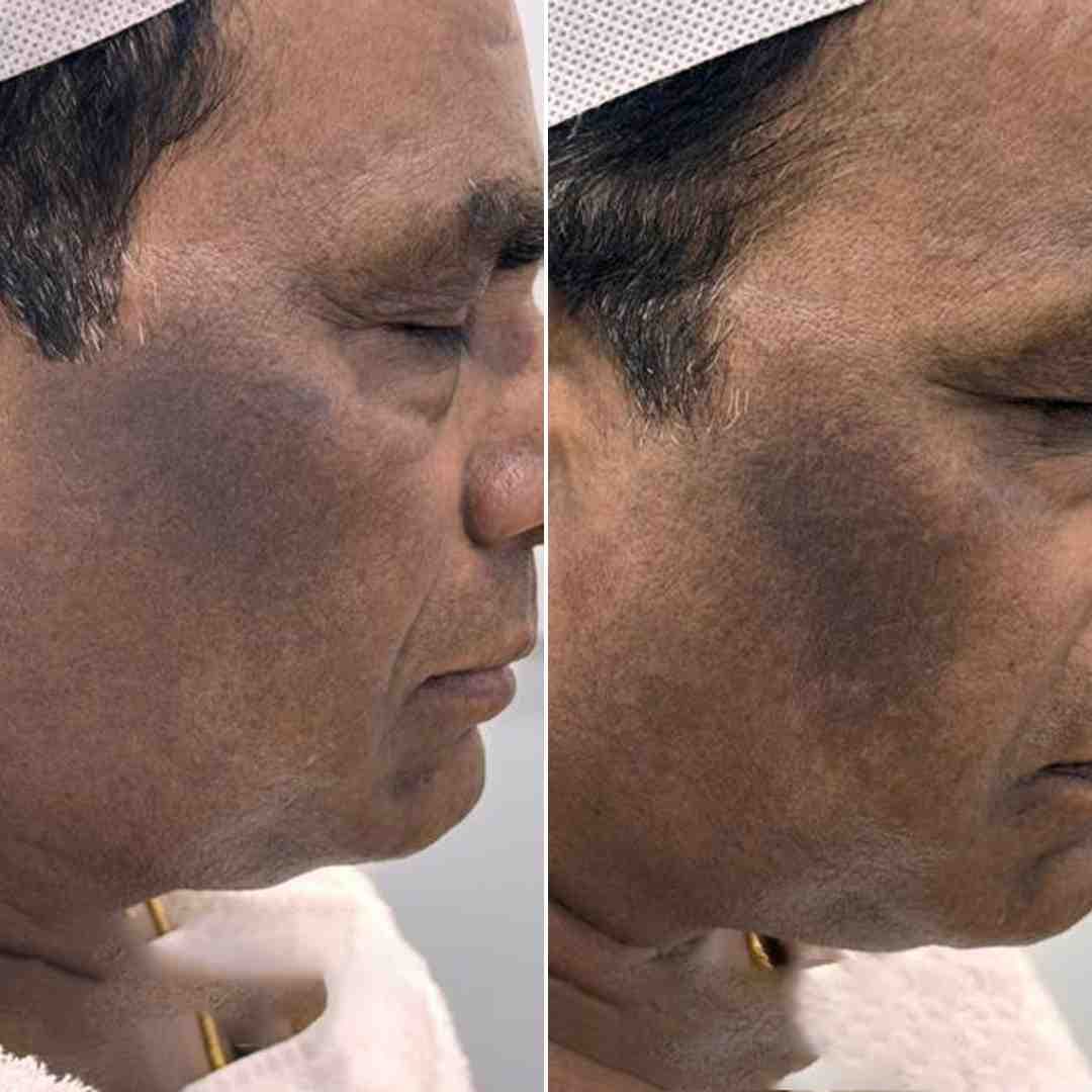 Cosmelan-Hyperpigmentation.jpg