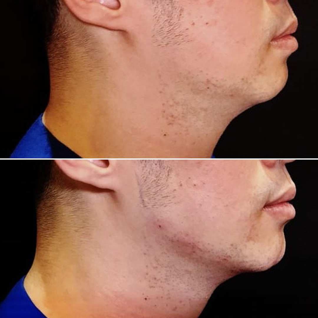Jaw-Filler.jpg