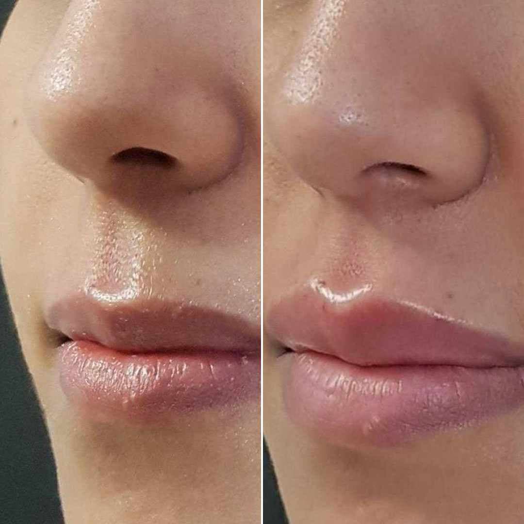 Lip-filler-11.jpg