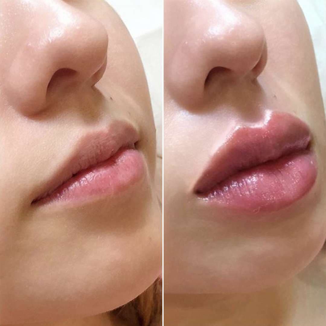 Lip-filler-8.jpg
