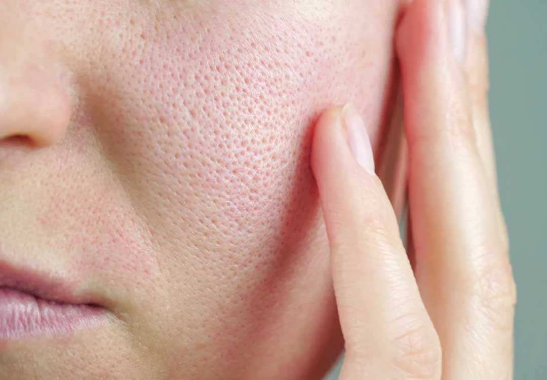 Enlarged or Open Pores