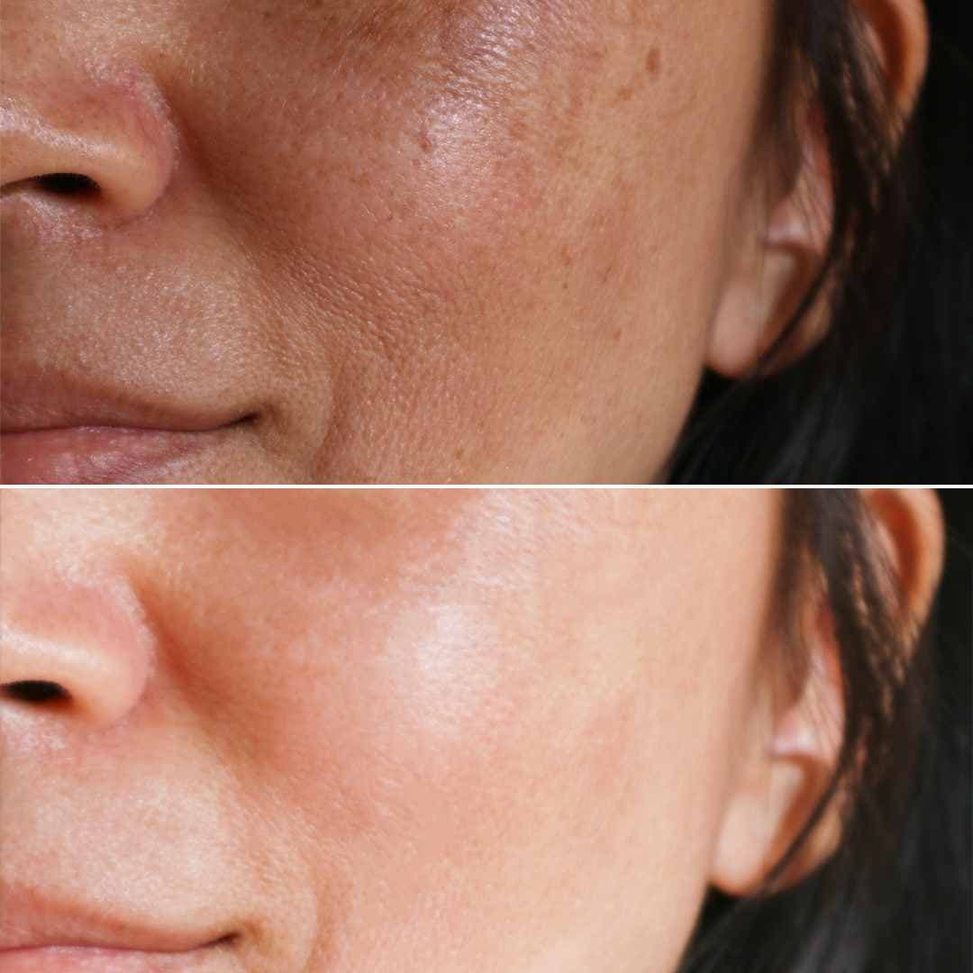 Skin Booster Injectables.jpg