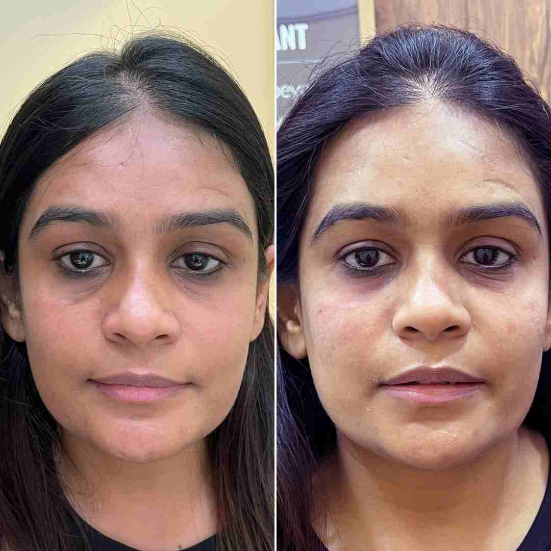 Under-eye-filler... (1).jpg