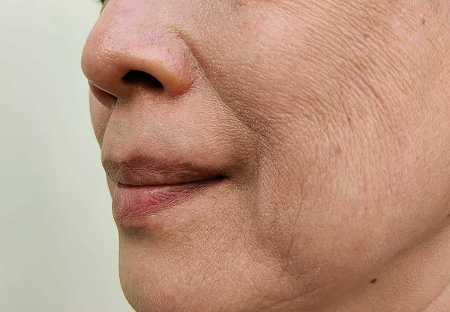 Wrinkles & Fine Lines