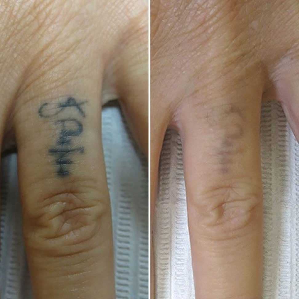 tattoo-removal.jpg