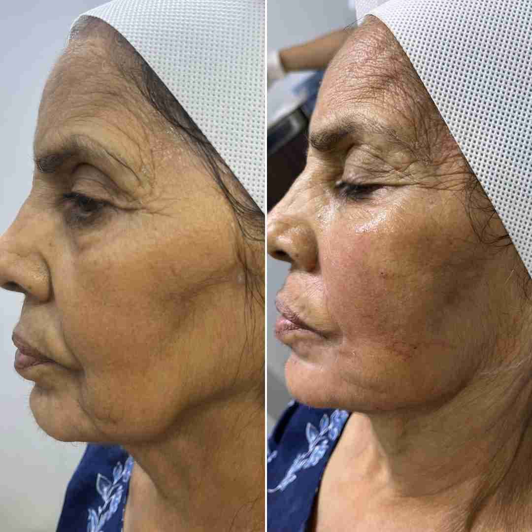 Botox-+-Filler1b-IMG-20240429-WA0012.jpg
