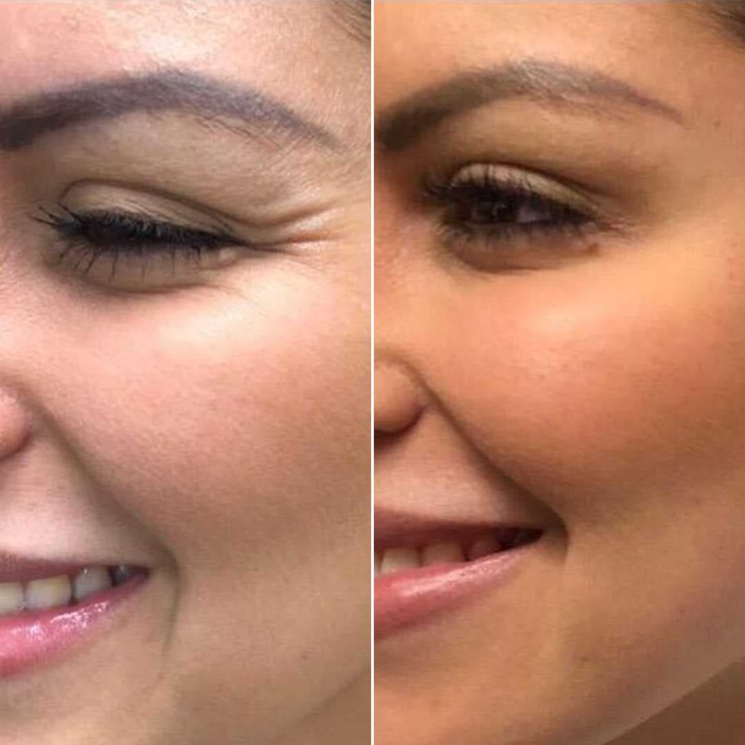 Copy of Botox-Crow_s-Feet-A.jpg