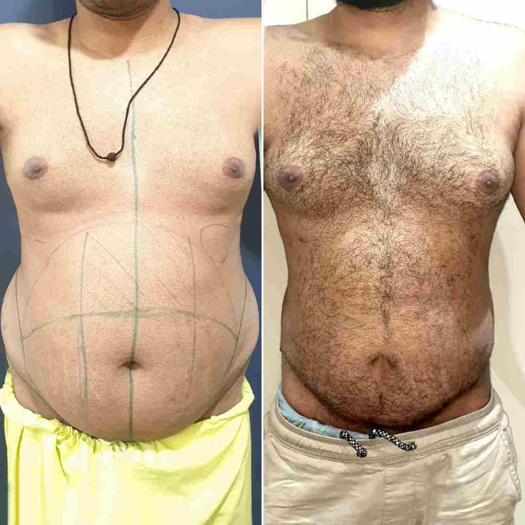Liposuction-+-Mini-tummy-tuck.jpg
