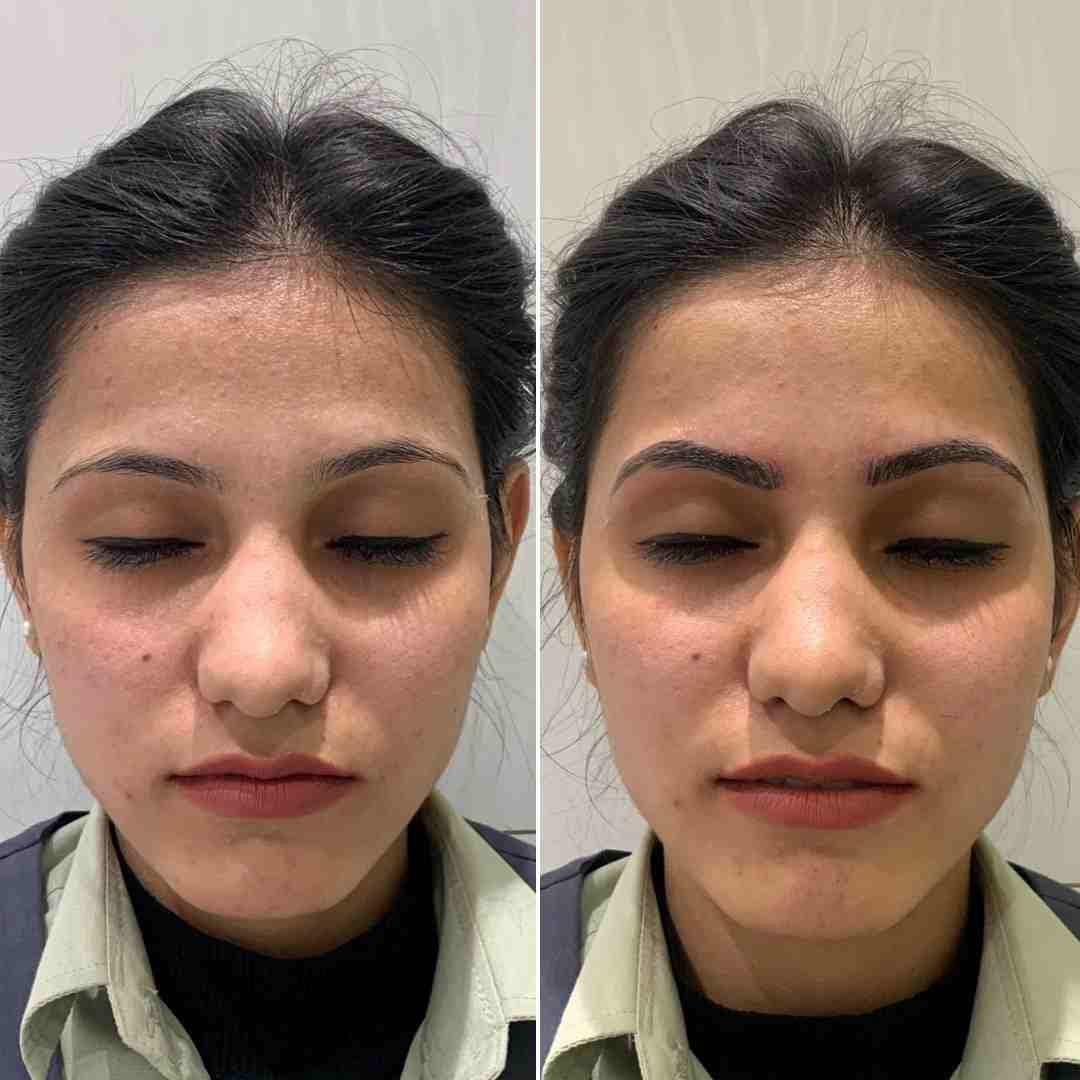 Micropigmentation Scalp Ibrow.jpg(1).jpg